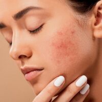 Pimple removal tips : पिंपल को हटाने की घरेलू आसान और असरदार टिप्स