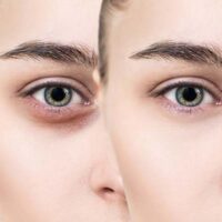 डार्क सर्कल्स से कैसे छुटकारा पाए ( how to get rid off dark circles):